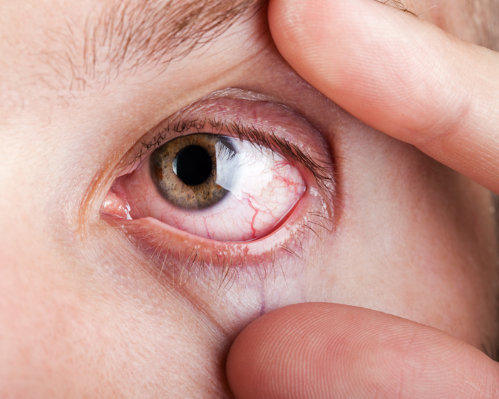 síndrome do olho seco