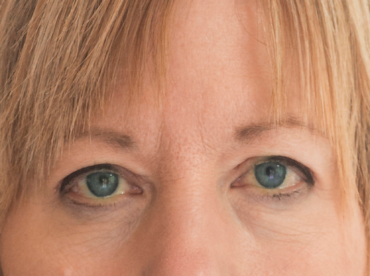 Representando o que é a ptose, a fotografia mostra em foco o rosto de uma mulher branca, cabelos loiros aparecendo, olhos azuis, sinais da idade na pele, com pálpebras superiores caídas.