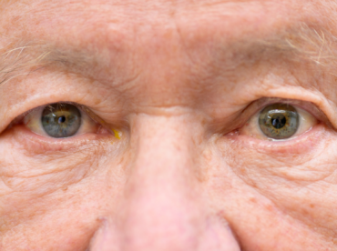 Em foco a fotografia mostra o rosto de um homem idoso, branco, de olhos esverdeados, em que há a presença da pupila anisocoria, sendo a da esquerda bem pequena e a da direita em tamanho regular.