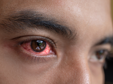 Representando o que são a esclerite e episclerite, a fotografia está em zoom no rosto de um homem jovem, negro, mostrando apenas a região dos olhos até as sobrancelhas, com um dos olhos em ênfase, que é castanho e está com a região de toda a parte branaca do olho (a esclera), fortemente avermelhada.
